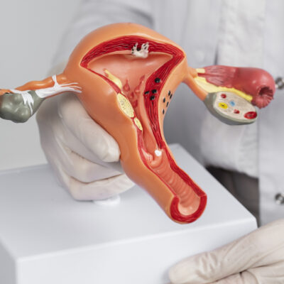 Ovarian cysts surgery